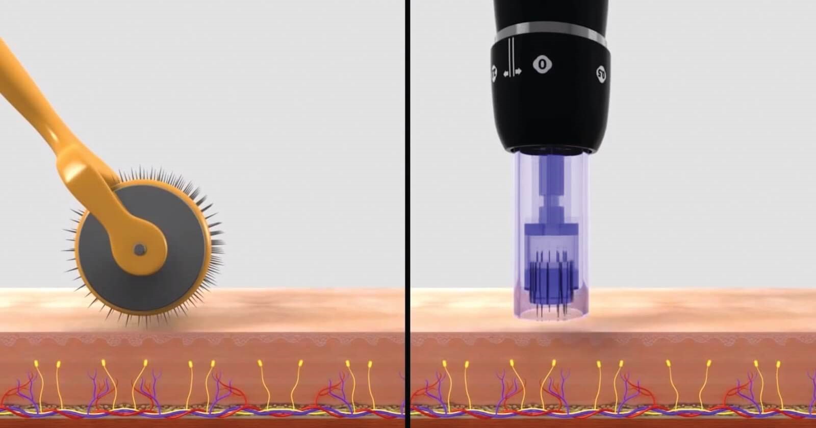 Microagulhamento com Dermapen em Campinas